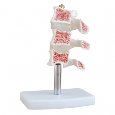 切開型骨質疏松癥